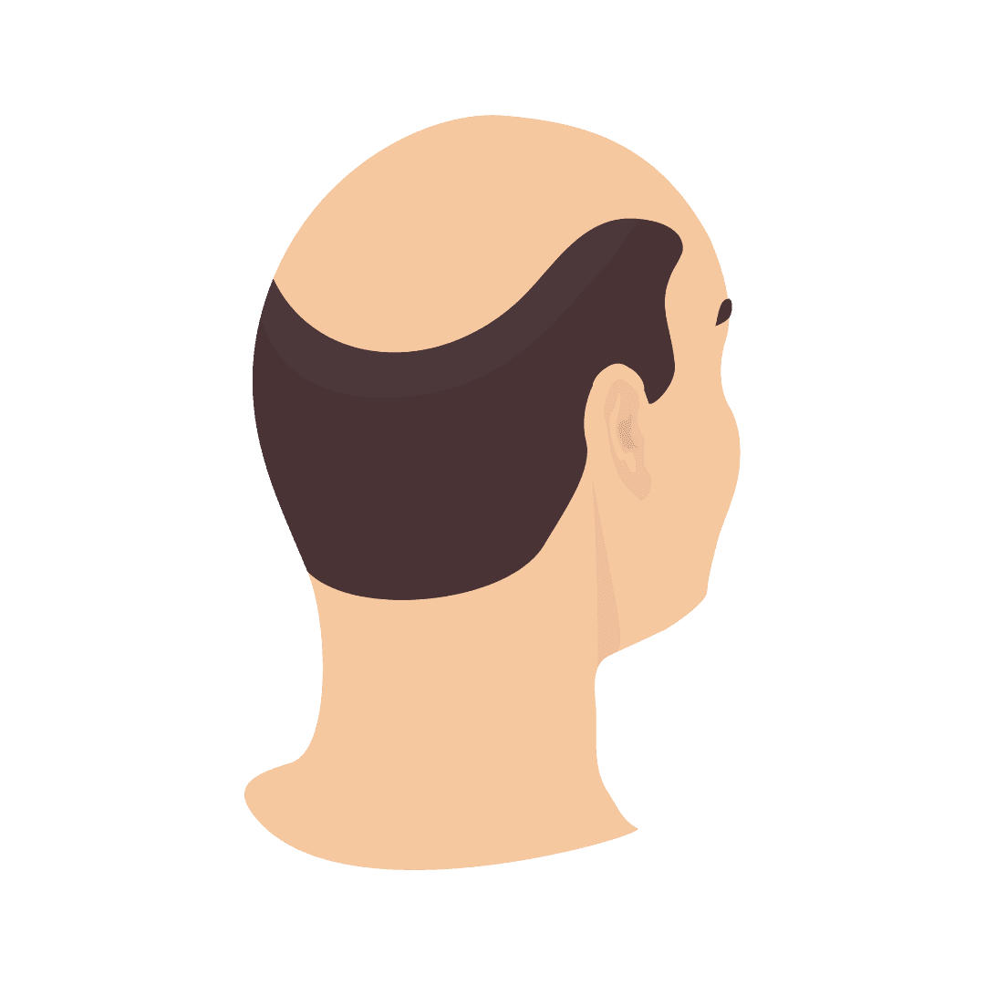 Alopezie (Kahlheit, Haarausfall)