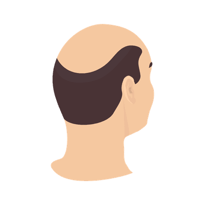 Alopezie (Kahlheit, Haarausfall)