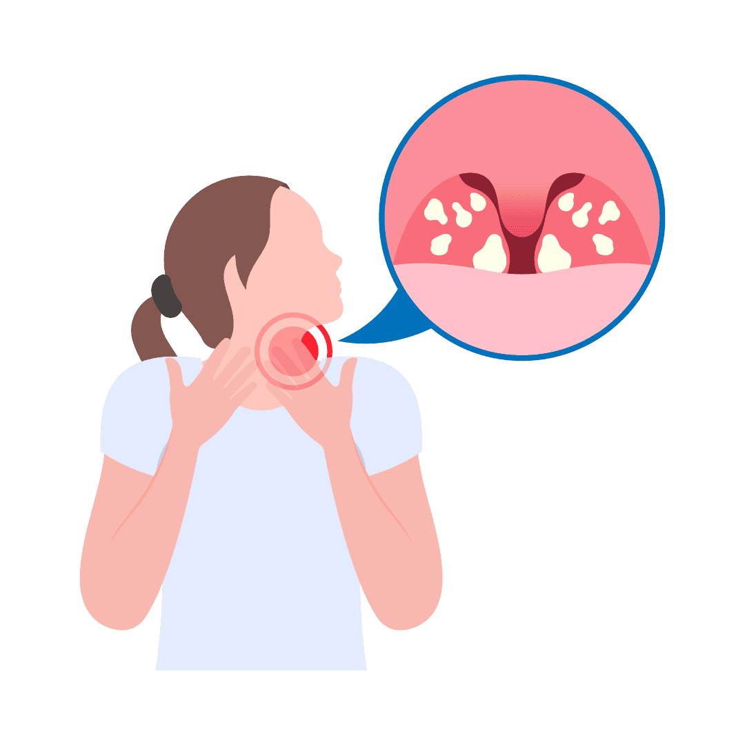Angina und Mandelentzündung
