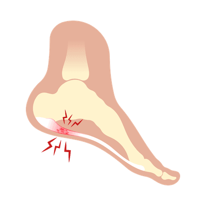 Fersensporn (Osteophyt)