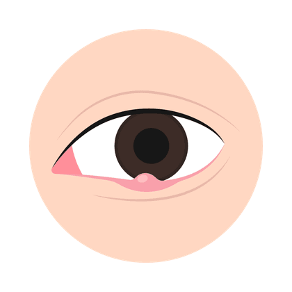 Gerste (hordeolum)